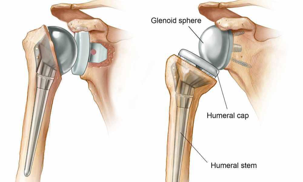 Shoulder Replacement at Osteon Orthopedic Hospital, Pimple Saudagar
