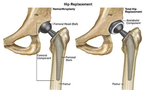 Total Hip Replacement at Osteon Orthopedic Hospital, Pimple Saudagar