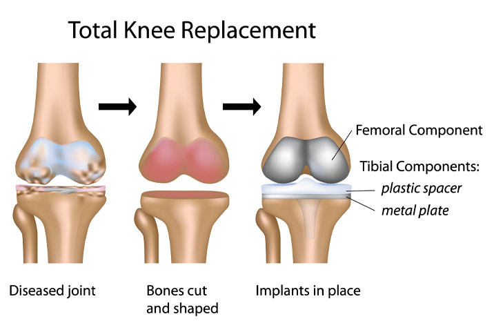 Robotic Knee Replacement at Osteon Orthopedic Hospital, Pimple Saudagar